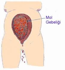  mol-gebelik--uzum-gebeligi