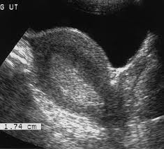  rahim-zari-kalinlasmasi--endometrial-hiperplazi