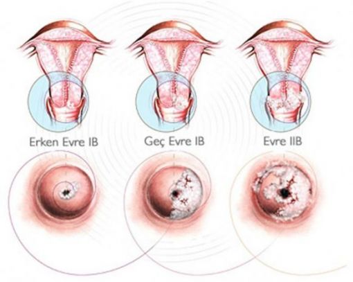  rahim ağzı kanseri, serviks kollum kanseri evreleri