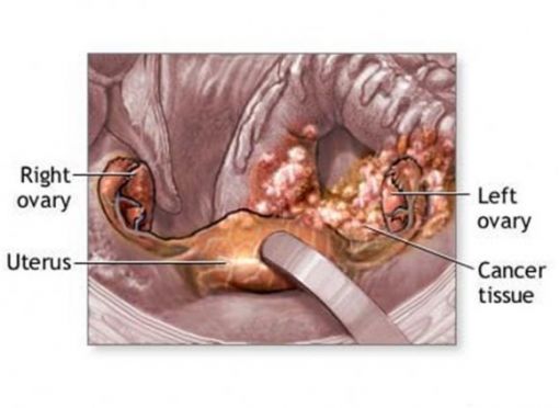  yumurtalık - over kanseri